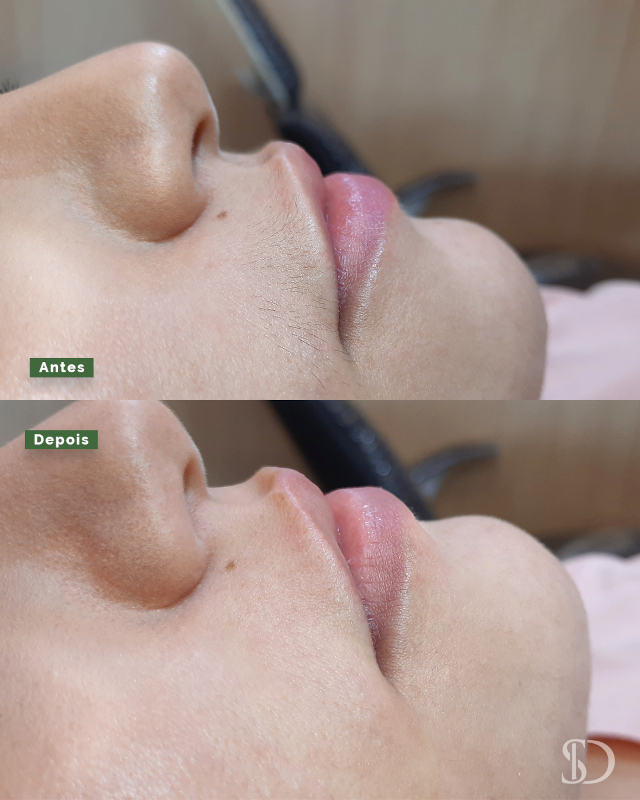 Epilação Facial SD